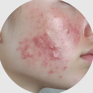 炎症ニキビ（赤ニキビ）